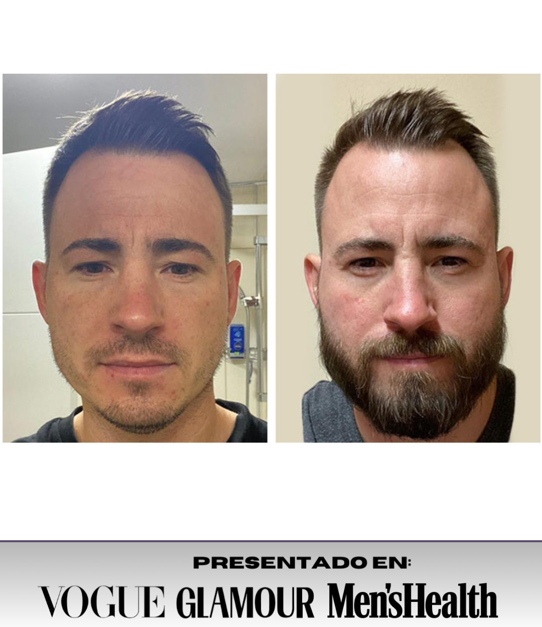 IRONBEARD® - Sérum Crece Barba + Regalo